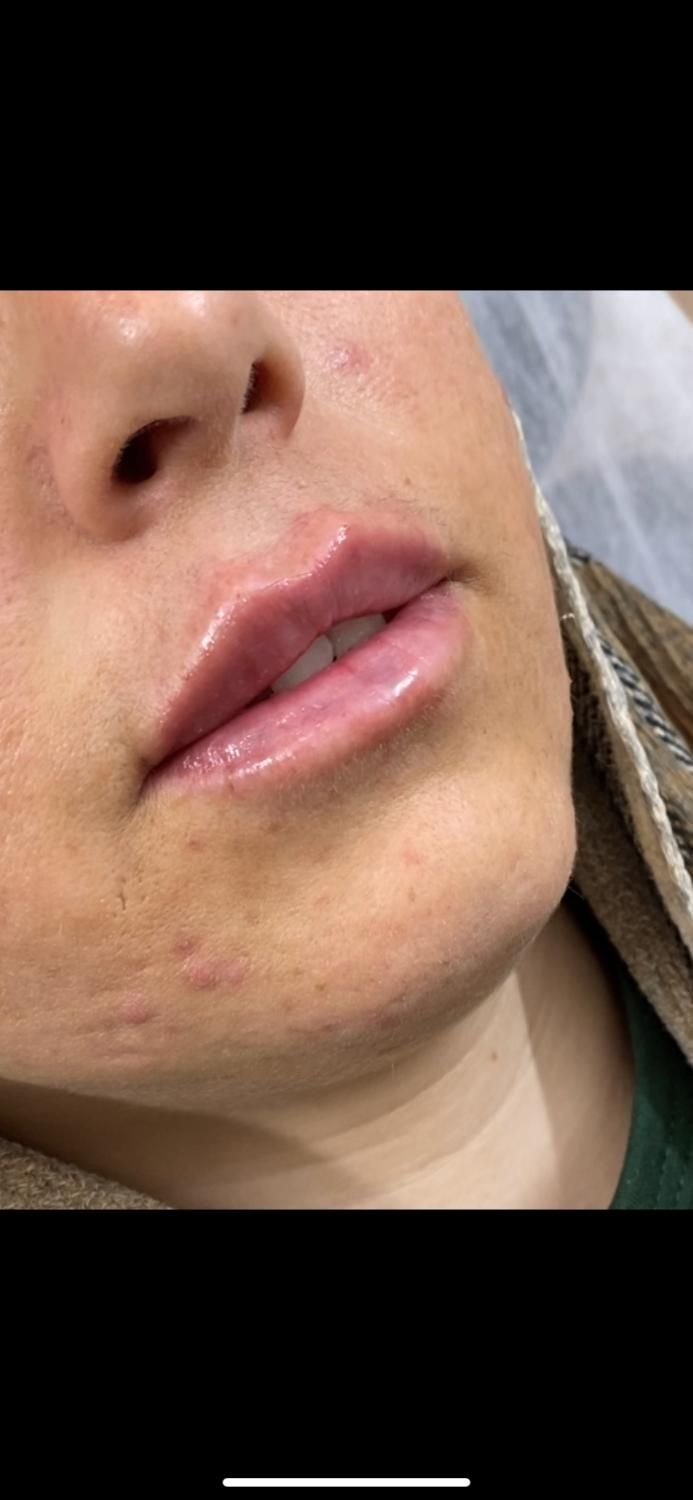 ژل لب متود روسی توسط پزشک حرفه ای|خدمات آرایشگری و زیبایی|حمیدیا, |دیوار