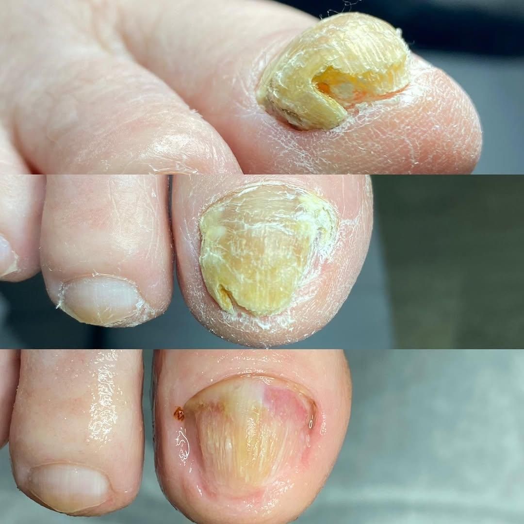 بیماری های ناخن تیرگی قوزک پدیکور آقایان و خانم ها|خدمات آرایشگری و زیبایی|زنجان, |دیوار