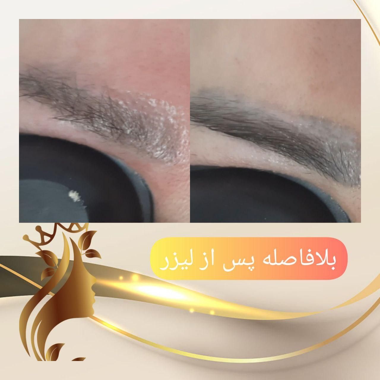 ریموو تتو با لیزر کیوسوئیچ و روشن سازی نواحی تیره|خدمات آرایشگری و زیبایی|قم, زنبیل آباد|دیوار
