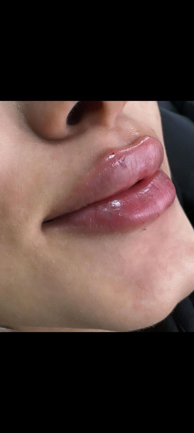 تزریق ژل و بوتاکس|خدمات آرایشگری و زیبایی|بیرجند, |دیوار