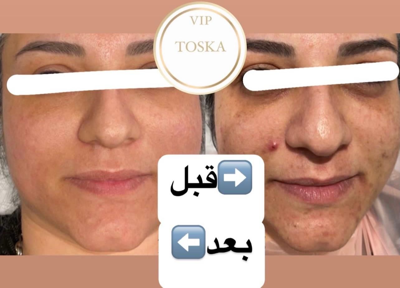 کرم ضدلک و ضدجوش قوی (vip توسکا)|خدمات آرایشگری و زیبایی|تهران, استاد معین|دیوار