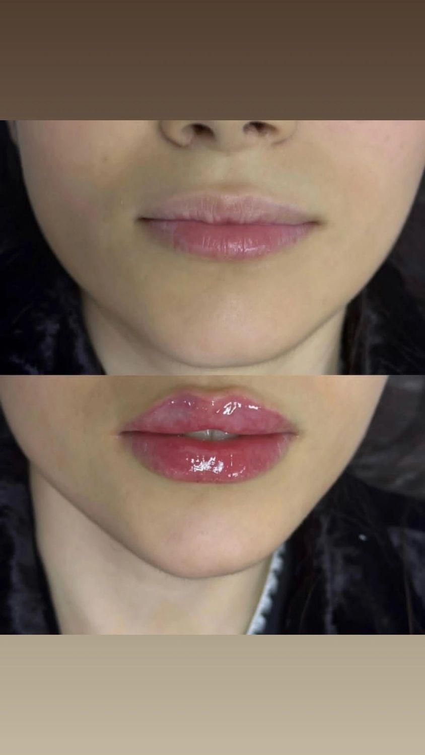 فیلر لب ، خط خنده، زاویه ، مزو فقط ۱۸۰۰|خدمات آرایشگری و زیبایی|محمدیه-قزوین, |دیوار