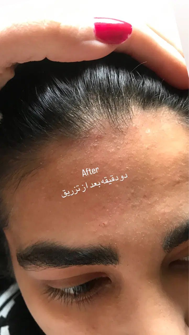پاکسازی و فیشیال پوست  ازبین بردن لک مخصوص بانوان|خدمات آرایشگری و زیبایی|آمل, |دیوار