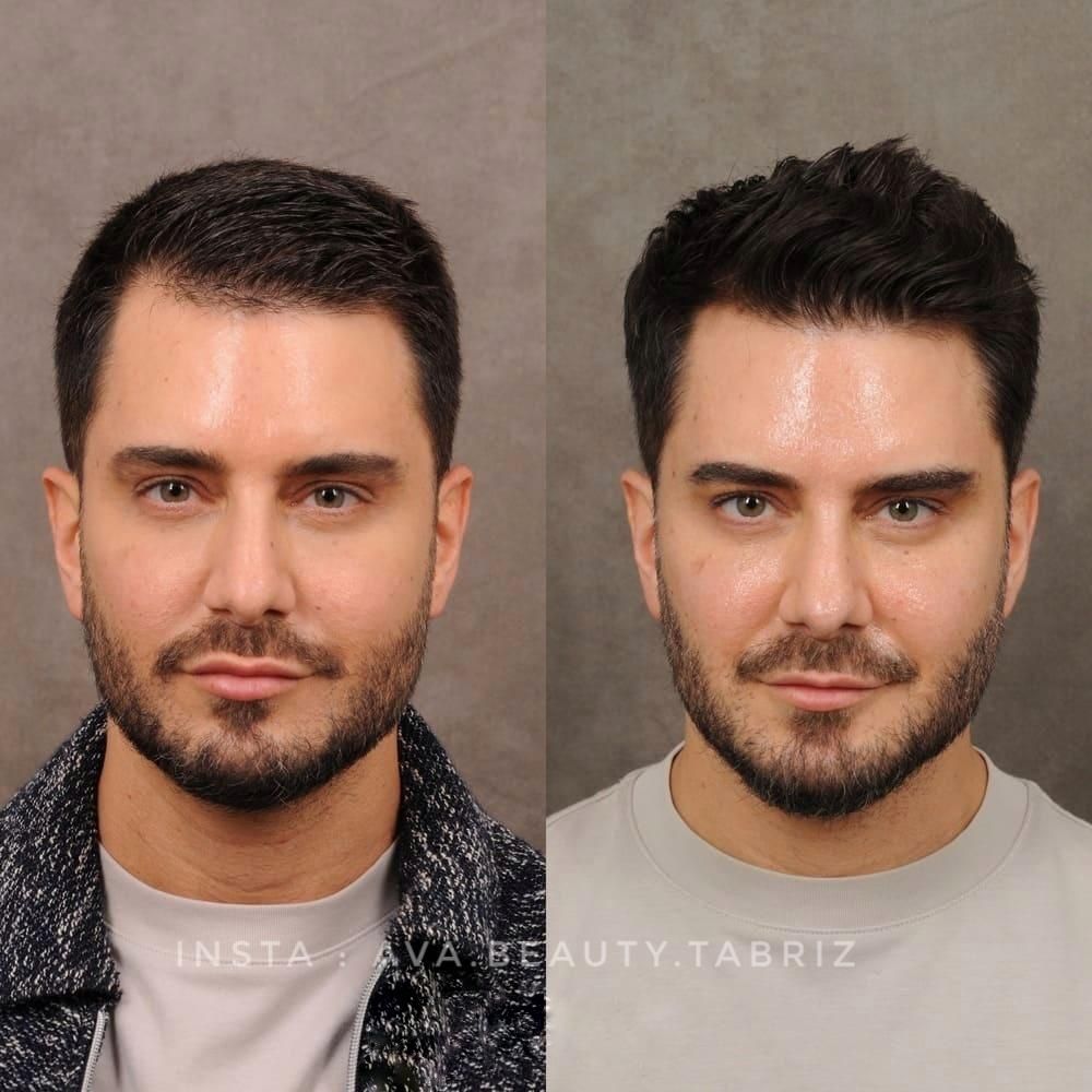 پی آر پی *بدون‌درد* prp قطع ریزش مو با ضمانت  365ت|خدمات آرایشگری و زیبایی|تبریز, |دیوار