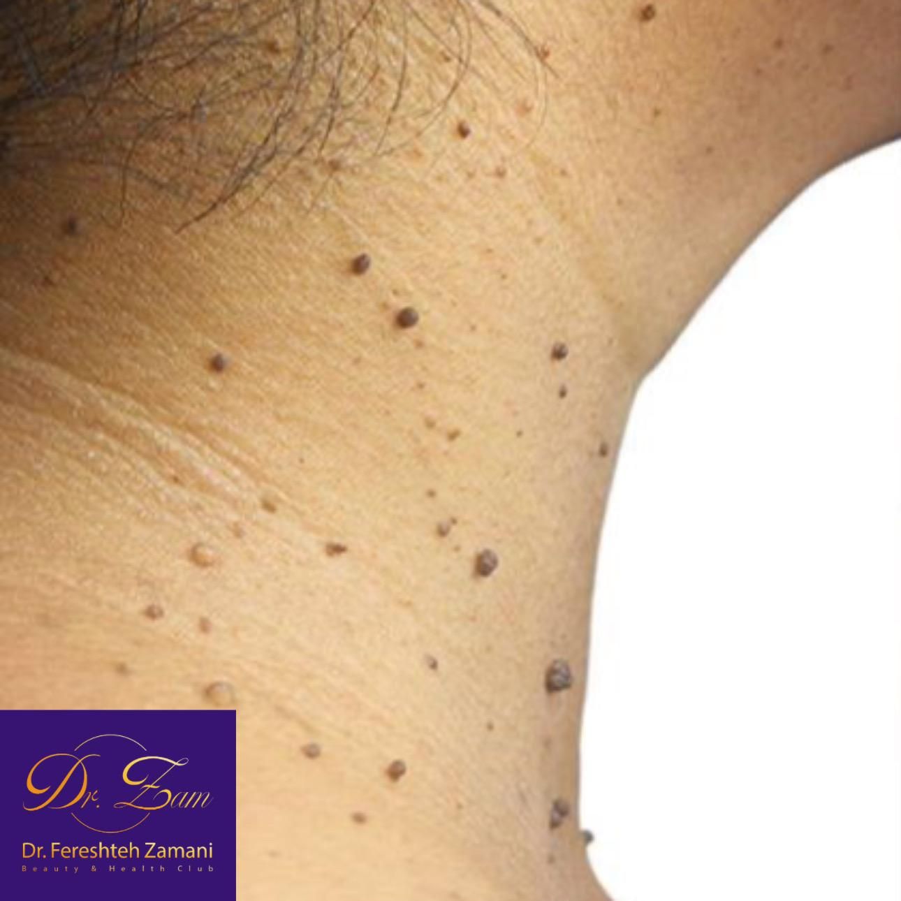 برداشتن خال و زگیل پوستی فقط 100|خدمات آرایشگری و زیبایی|محمدیه-قزوین, |دیوار