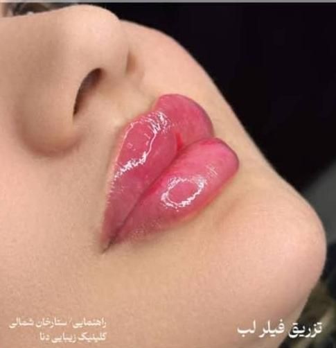 فیلرصورت بوتاکس کربن هایفو لیزرمو ریموتتو جوانسازی|خدمات آرایشگری و زیبایی|یاسوج, |دیوار