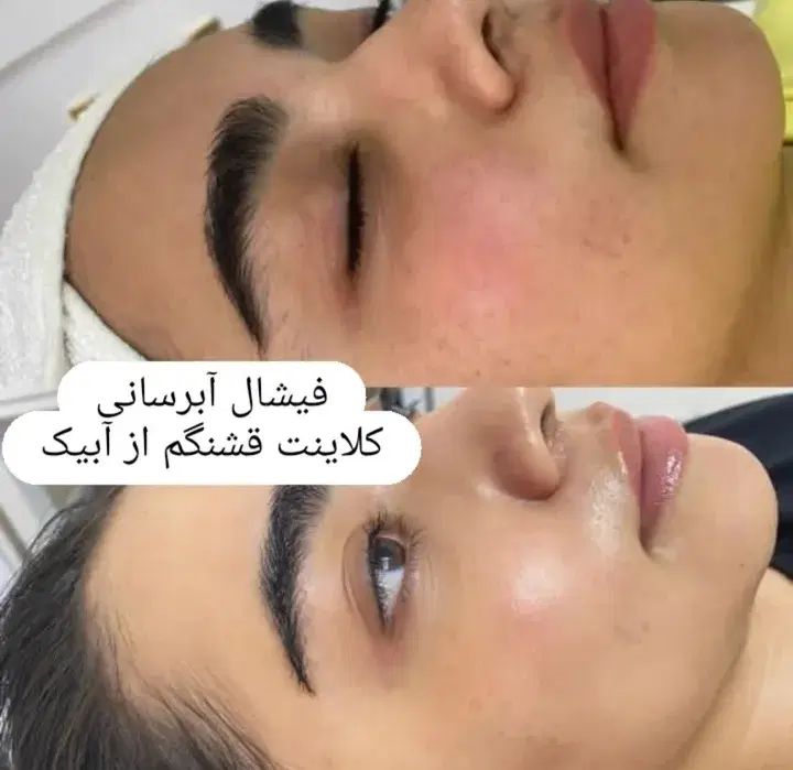 مدل  رایگان  فقط هزینه مواد مزوتراپی وفشیال و تتو|خدمات آرایشگری و زیبایی|فردیس, دهکده|دیوار