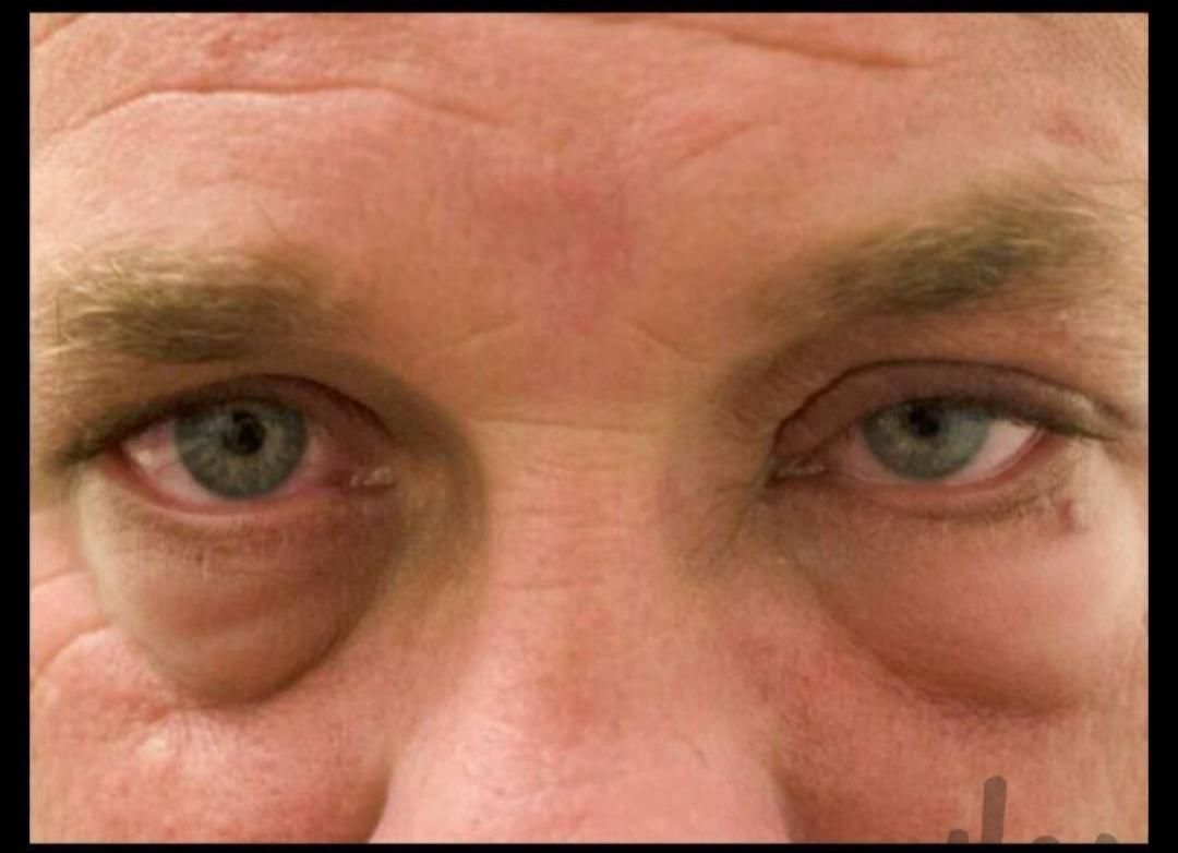 عمل زیبائی پلک و عمل رفع پف زیر چشم|خدمات آرایشگری و زیبایی|شاهینشهر, |دیوار