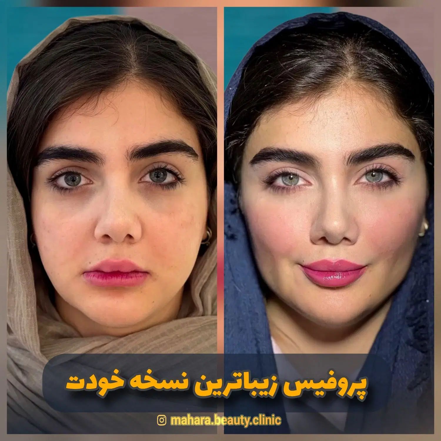 تخفیف یانگ فیس صورت ابرو پزشک پوست مو بینی زیبایی|خدمات آرایشگری و زیبایی|مشهد, هفت تیر (آب و برق)|دیوار