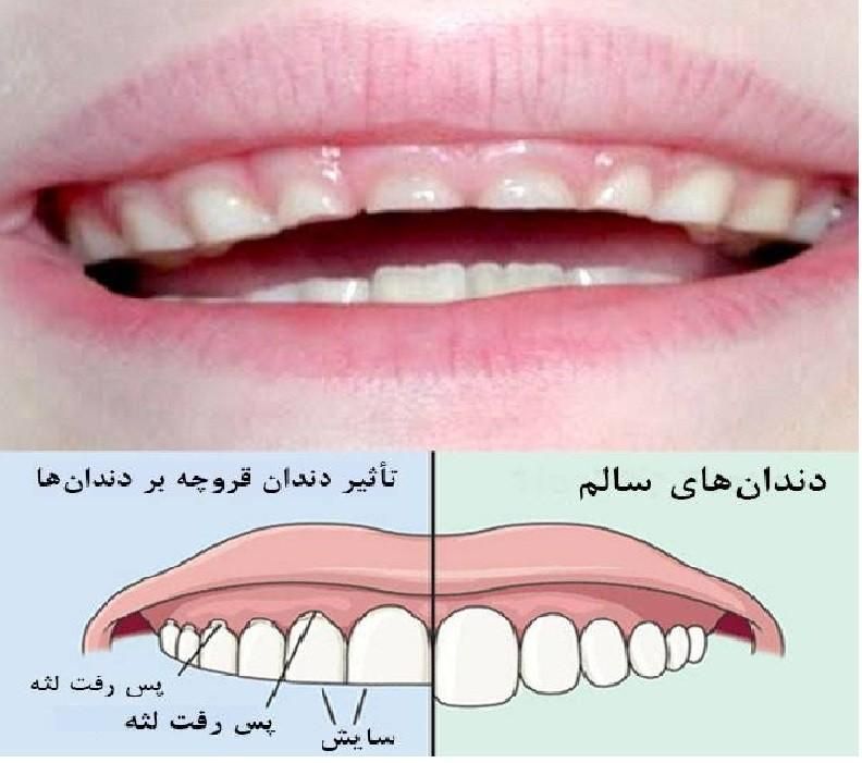 کلینیک نایت گارد دندان مصنوعی متحرک تضمینی|آرایشی، بهداشتی، درمانی|صفادشت, |دیوار