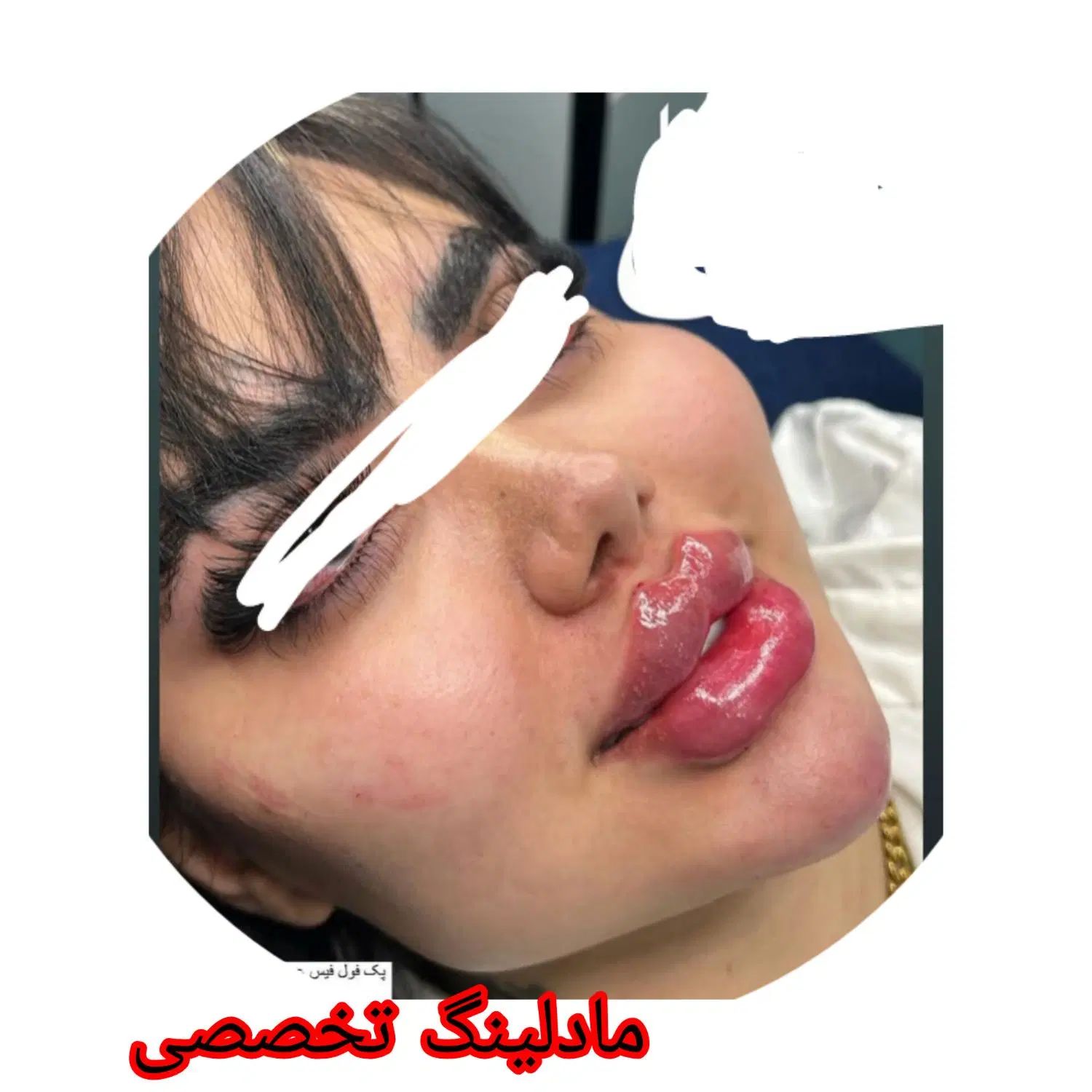 تزریق چربی. .مادلینگ .شکم .پهلو درکلینیک تخصصی|خدمات آرایشگری و زیبایی|کرمانشاه, |دیوار
