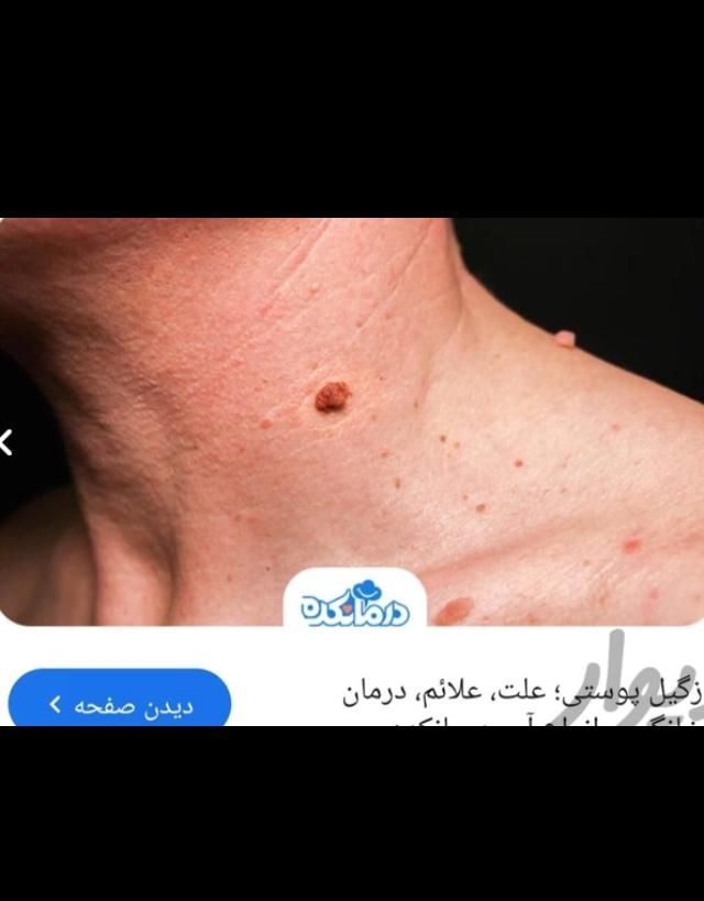 خدمات پرستاری و درمان و برداشتن انواع زگیل|خدمات آرایشگری و زیبایی|یاسوج, |دیوار