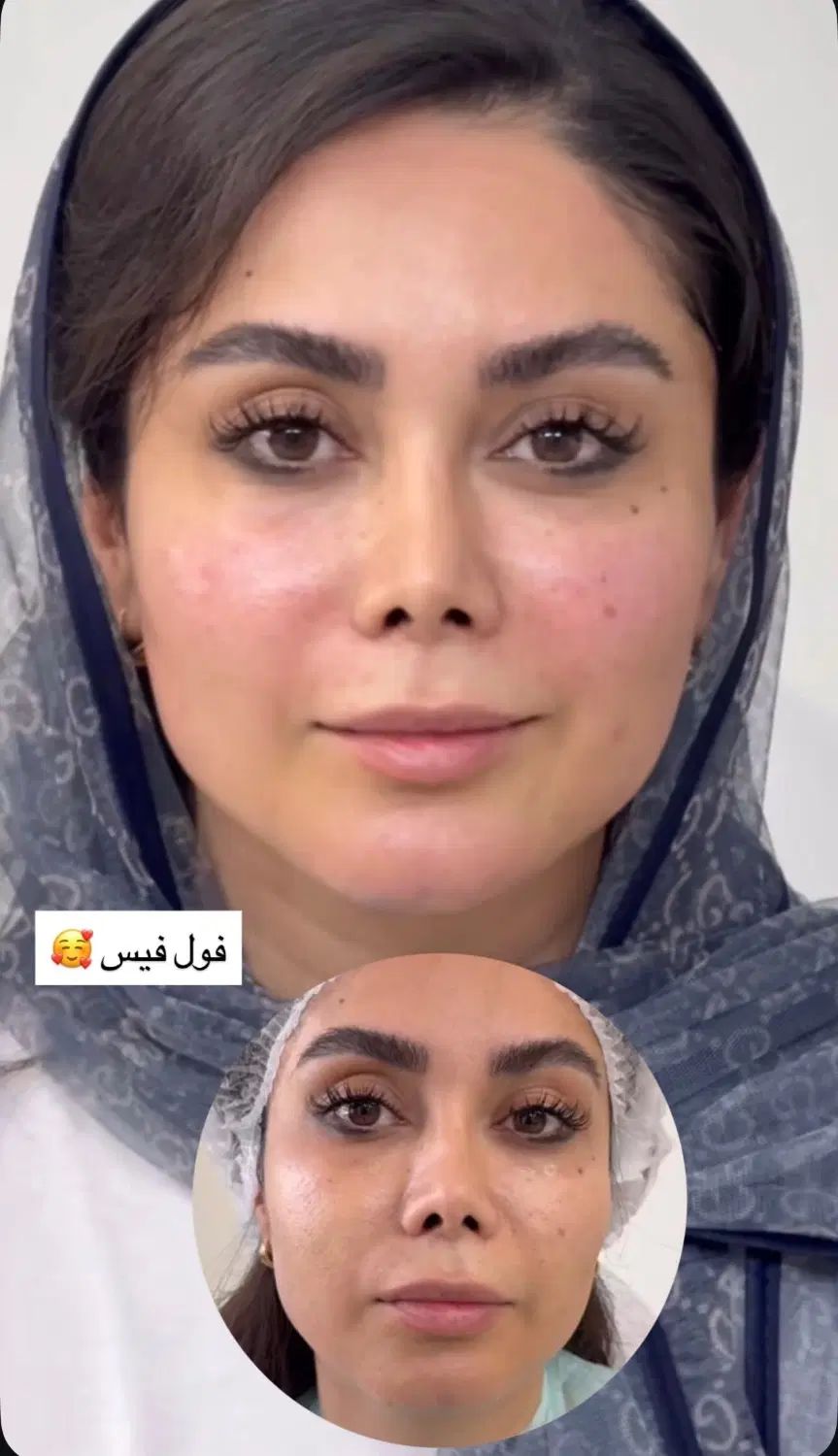 تخفیفات استثنایی ژل و بوتاکس در مطب زیبایی|خدمات آرایشگری و زیبایی|قم, زنبیل آباد|دیوار