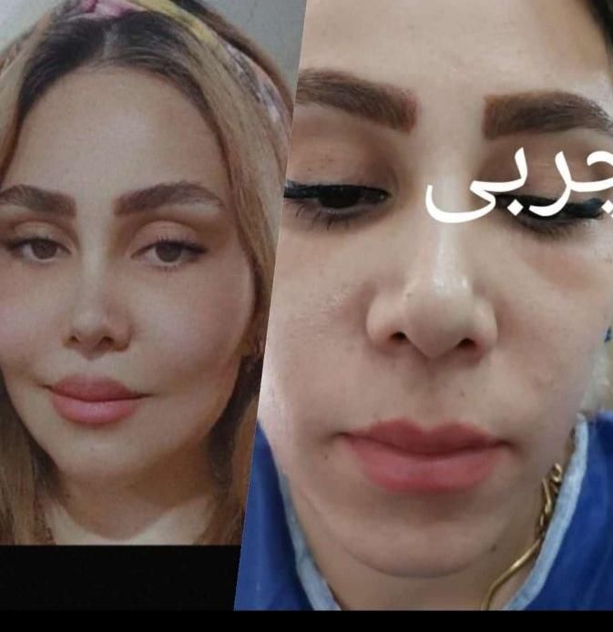 تزریق چربی ساکشن چربی ژل بوتاکس مزو چال گونه|خدمات آرایشگری و زیبایی|قم, بنیاد|دیوار