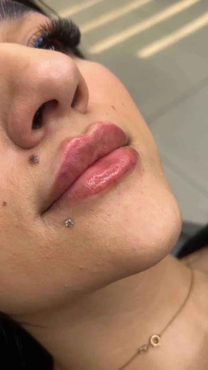 تزریق ژل ،بوتاکس ،لیزر موهای زائد، ساکشن غبعب|خدمات آرایشگری و زیبایی|تهران, صد دستگاه|دیوار