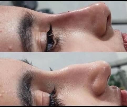 کلینیک تزریق ژل و بوتاکس .فیلر زیر چشم . آنزیم|خدمات آرایشگری و زیبایی|کرج, گوهردشت|دیوار