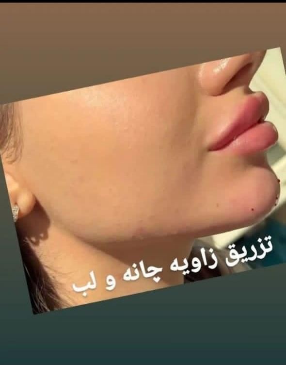 بوتاکس ،فیلر و ژل لب ، لیفت نخ ، انزیم ،مزوتراپی|خدمات آرایشگری و زیبایی|مشهد, جانباز|دیوار