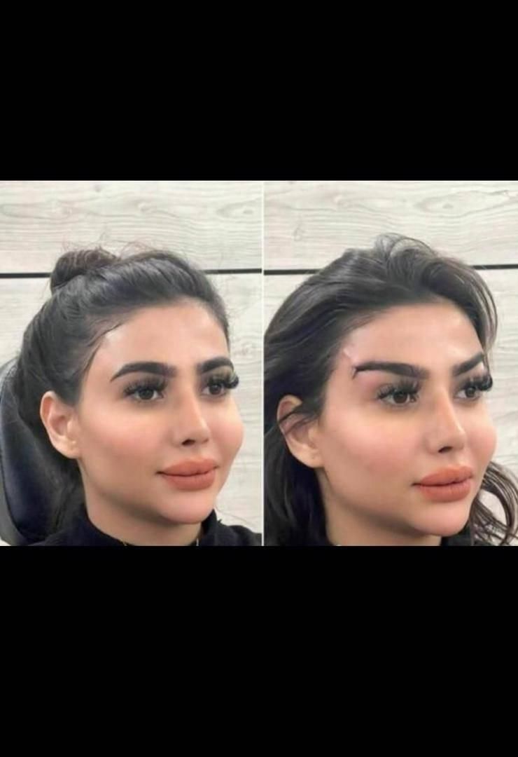 تزریق ژل فیلر مزوژل جوانساز بوتاکس لب روسی مزو مو|خدمات آرایشگری و زیبایی|کرج, گلشهر|دیوار