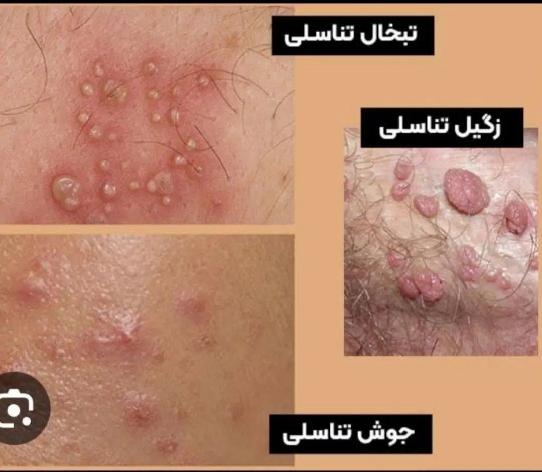 درمان قطعی زگیل بدون نیاز به جراحی و فریز|خدمات آرایشگری و زیبایی|گنبد کاووس, |دیوار