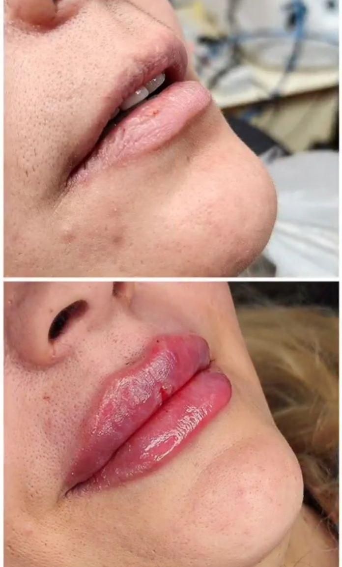 فیلر۶۰۰زیبایی صورت.لب با ژل/رفع چروک بابوتاکس۷۰۰|خدمات آرایشگری و زیبایی|برازجان, |دیوار