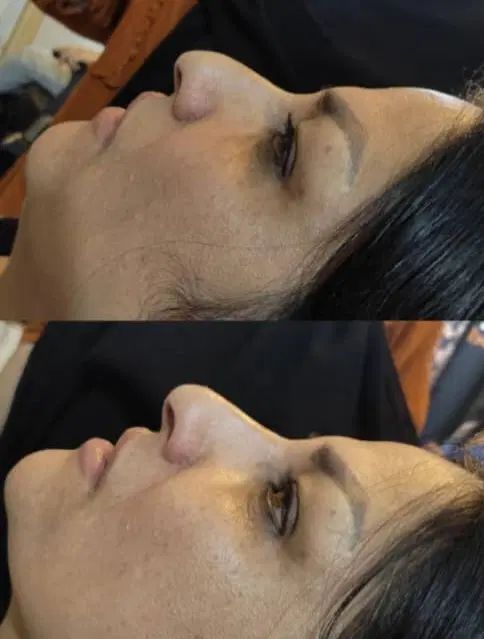 تزریق ژل و بوتاکس مزو تراپی جوانسازی تخلیه میلیا|خدمات آرایشگری و زیبایی|مشهد, ثامن|دیوار
