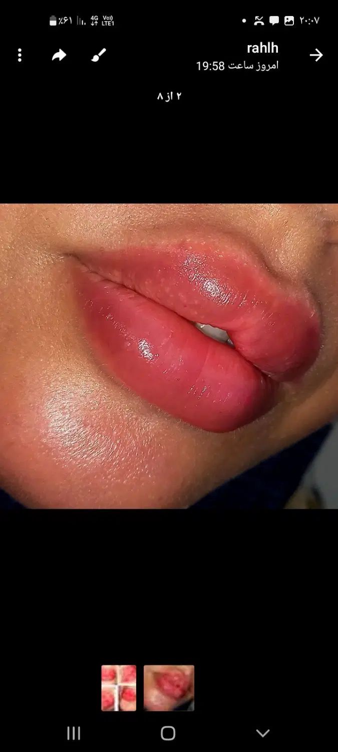 ژل وبوتاکس.برداشتن خال.فیلربینی انزیم پاککردن تاتو|خدمات آرایشگری و زیبایی|مشهد, طبرسی شمالی|دیوار