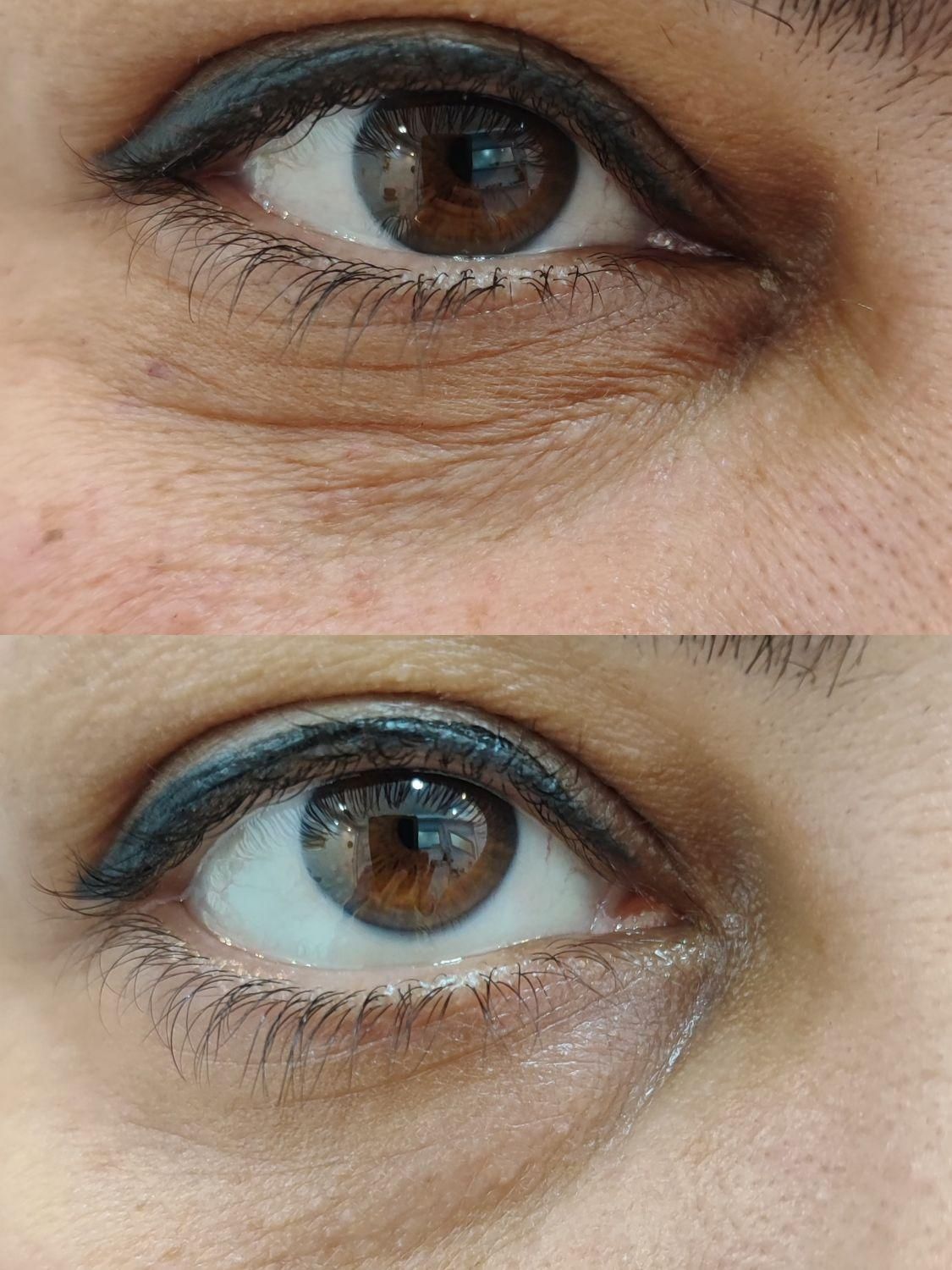 لیزر هایفو ژل بوتاکس ریمو تتو|خدمات آرایشگری و زیبایی|بوشهر, |دیوار