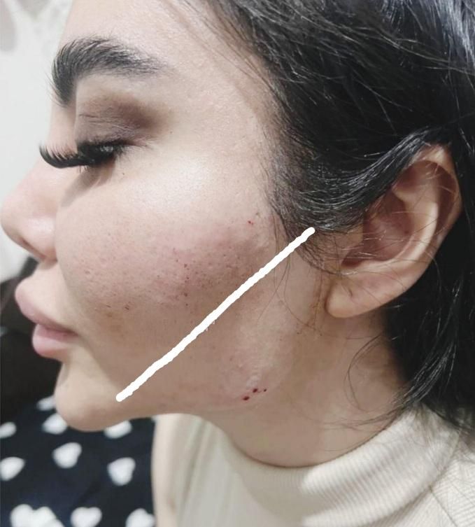 تزریق تخصصی ژل لب تزریق بادی لیفت نخ و چربی|خدمات آرایشگری و زیبایی|خرمشهر, |دیوار