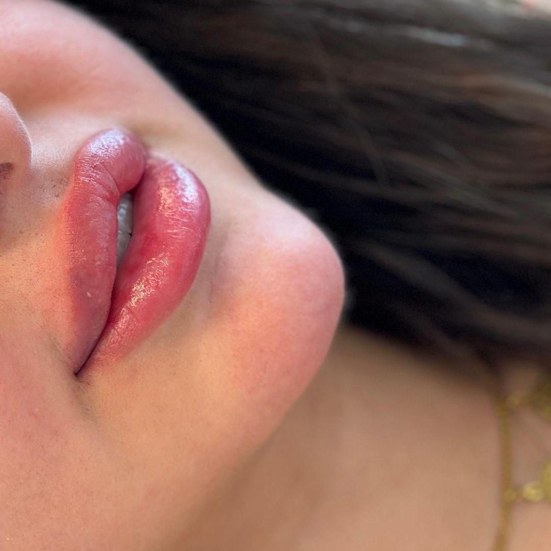 جشنواره تزریق فیلر ب مدت محدود فقط ۷۸۰تومن|خدمات آرایشگری و زیبایی|زنجان, |دیوار