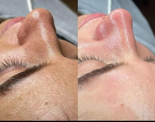 پاکسازی و فیشیال پوست|خدمات آرایشگری و زیبایی|باقرشهر, |دیوار