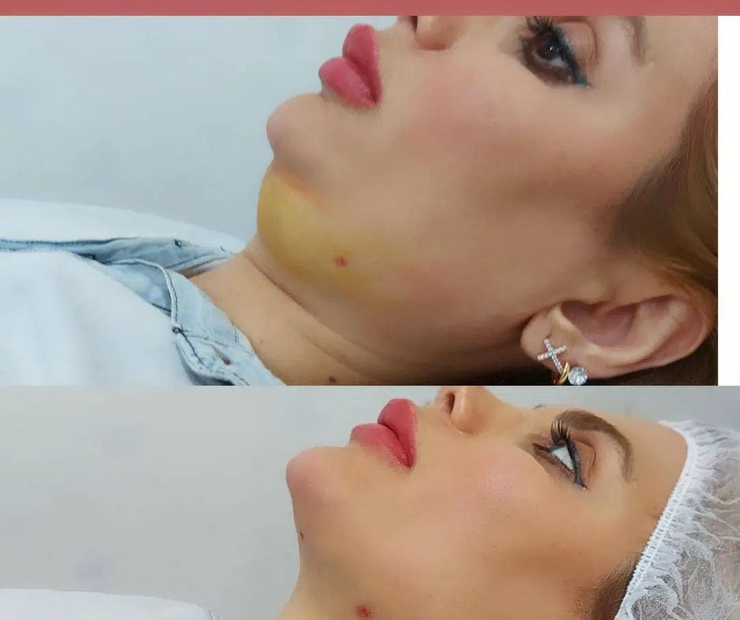 تزریق ژل بوتاکس چربی پی آرپی و زیبایی زنان|خدمات آرایشگری و زیبایی|اهواز, کیانپارس |دیوار
