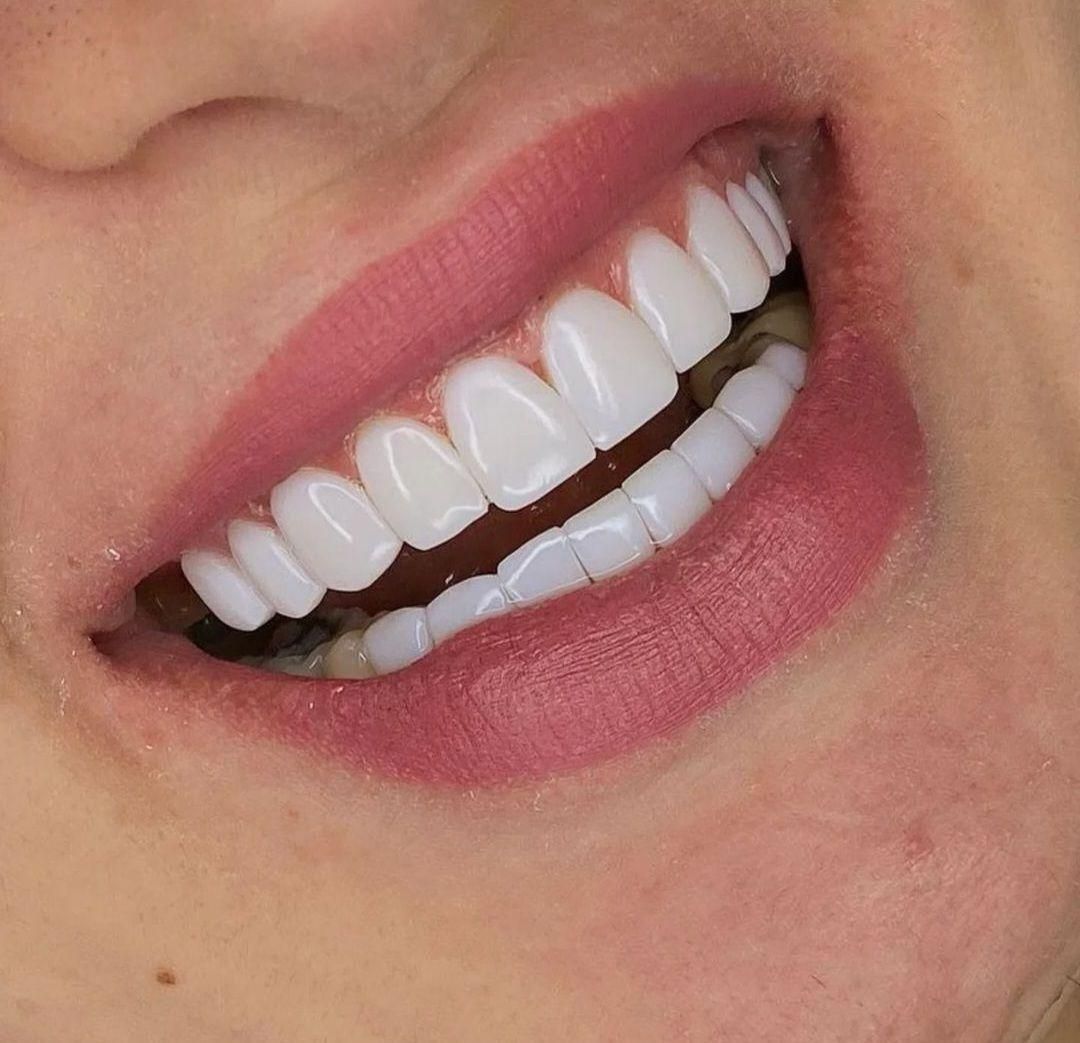 دندانپزشکی.کامپوزیت.روکش دندان.لمینت.ترمیم|خدمات آرایشگری و زیبایی|کرمانشاه, |دیوار