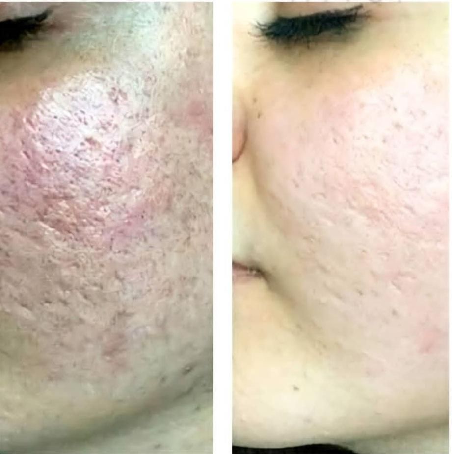 آموزش وخدمات فیشال،پی آرپی،مزوتراپی، مزونیدیلینگ|خدمات آرایشگری و زیبایی|کرج, گوهردشت|دیوار