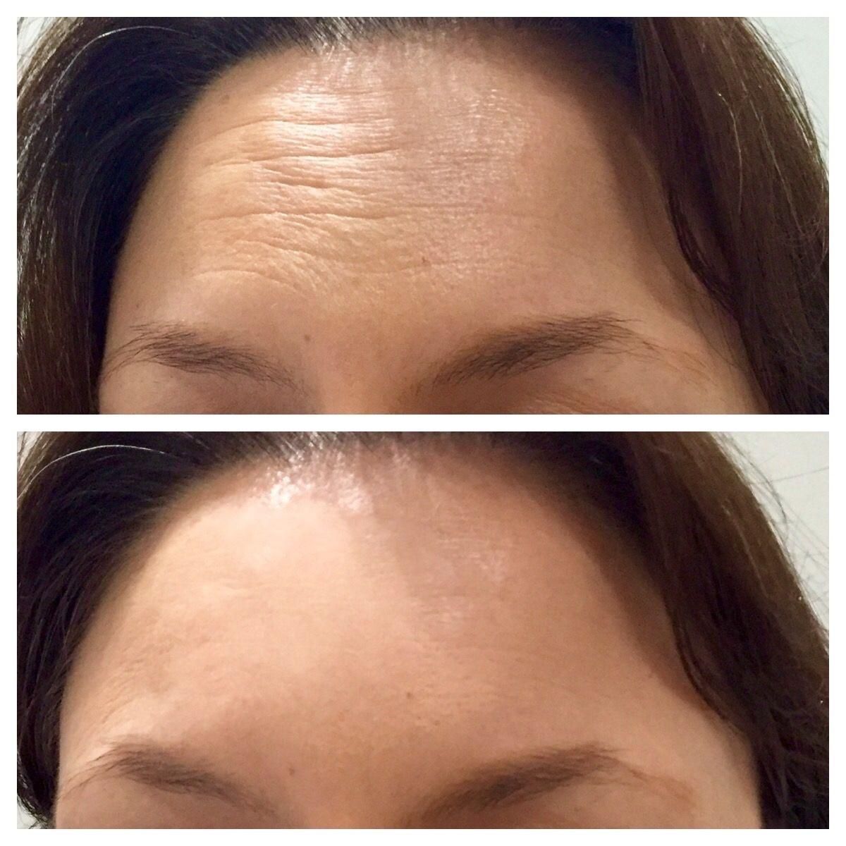 تزریق بوتاکس و فیلر با تخفیف ویژه|خدمات آرایشگری و زیبایی|قزوین, |دیوار