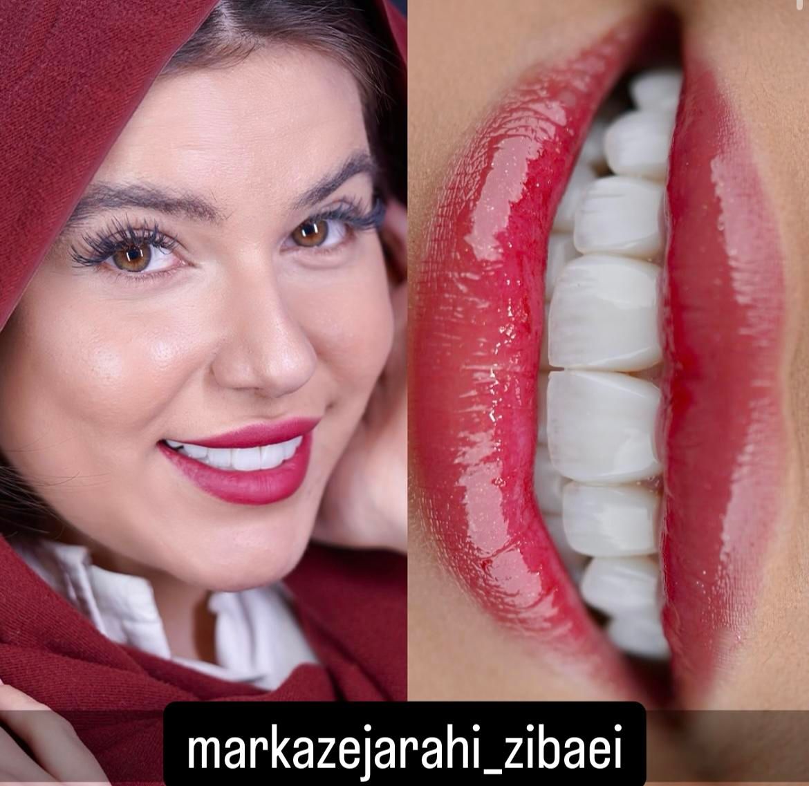 ایمپلنت کامپوزیت لمینت بلیچینگ عصب کشی ارتو|خدمات آرایشگری و زیبایی|مشهد, سجاد شهر|دیوار