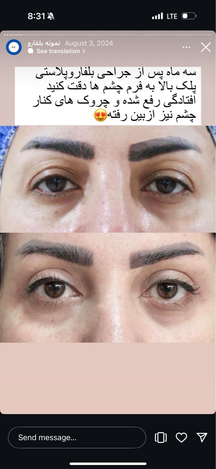 بلفارو پلک فیلر ژل لب ساکشن غبغب بوتاکس نخ سانترال|خدمات آرایشگری و زیبایی|اصفهان, مرداویج|دیوار