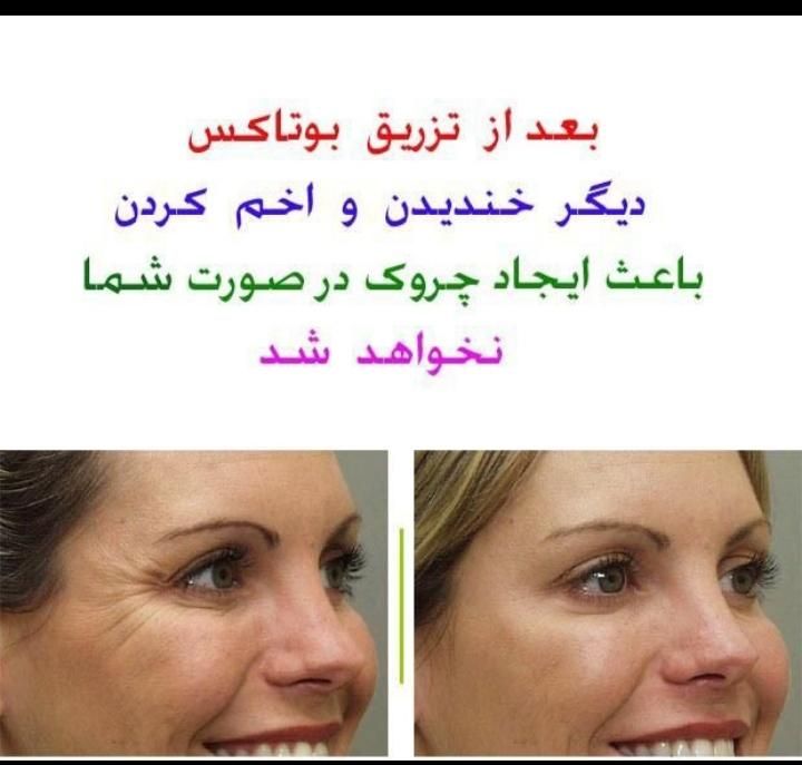لیزر کندلا اصل بانوان و اقایان (قیمتها شکسته شد)|خدمات آرایشگری و زیبایی|مشهد, وکیل‌آباد|دیوار