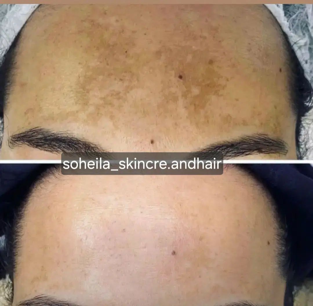 تخفیف ویژه رفع تیرگی بدن بادستگاه کیوسوییچ|خدمات آرایشگری و زیبایی|کرج, چهارصد دستگاه|دیوار