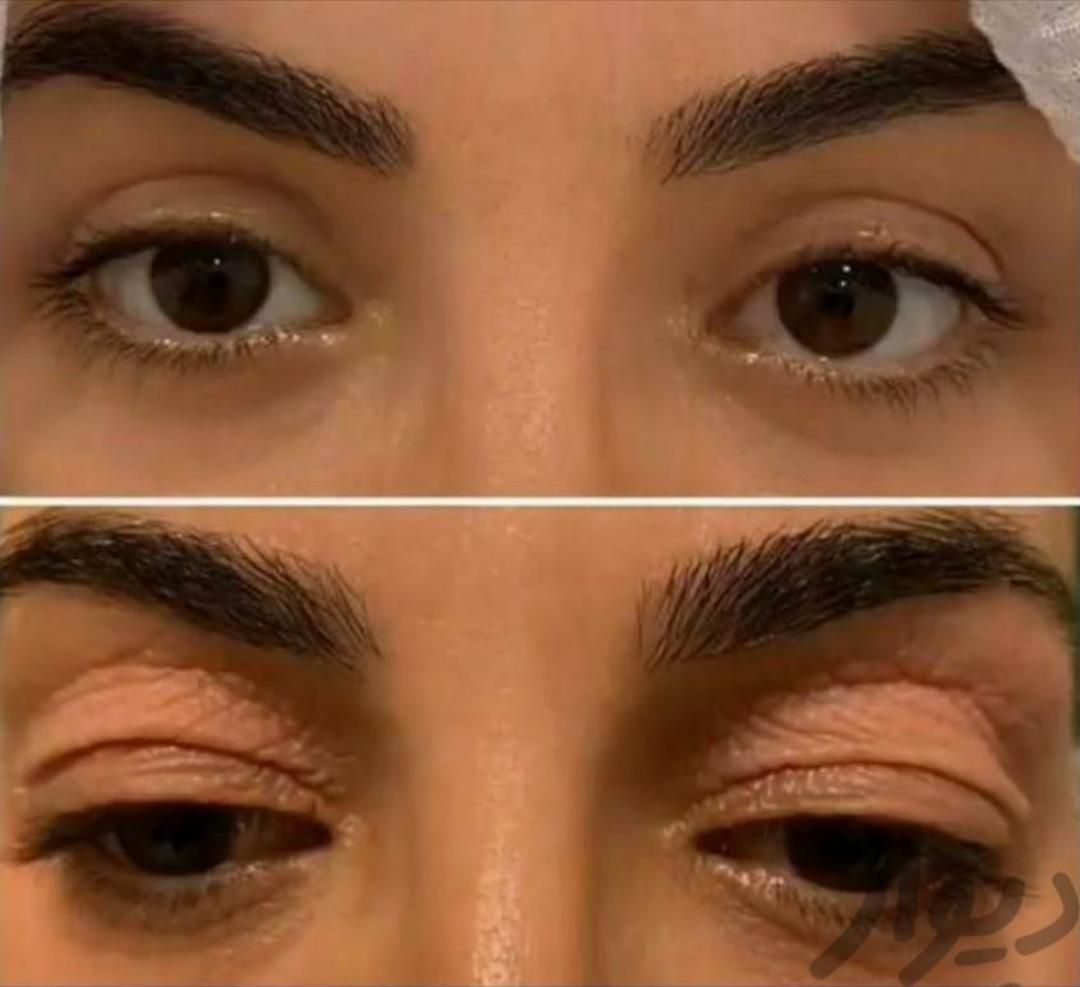 عمل زیبائی پلک و عمل رفع پف زیر چشم|خدمات آرایشگری و زیبایی|شاهینشهر, |دیوار
