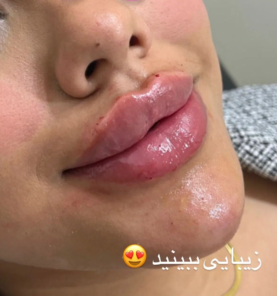 جشنواره مدل فیلر لب و نواحی مختلف صورت هر سیسی ۳۵۰|خدمات آرایشگری و زیبایی|رباط‌کریم, نصیرشهر|دیوار