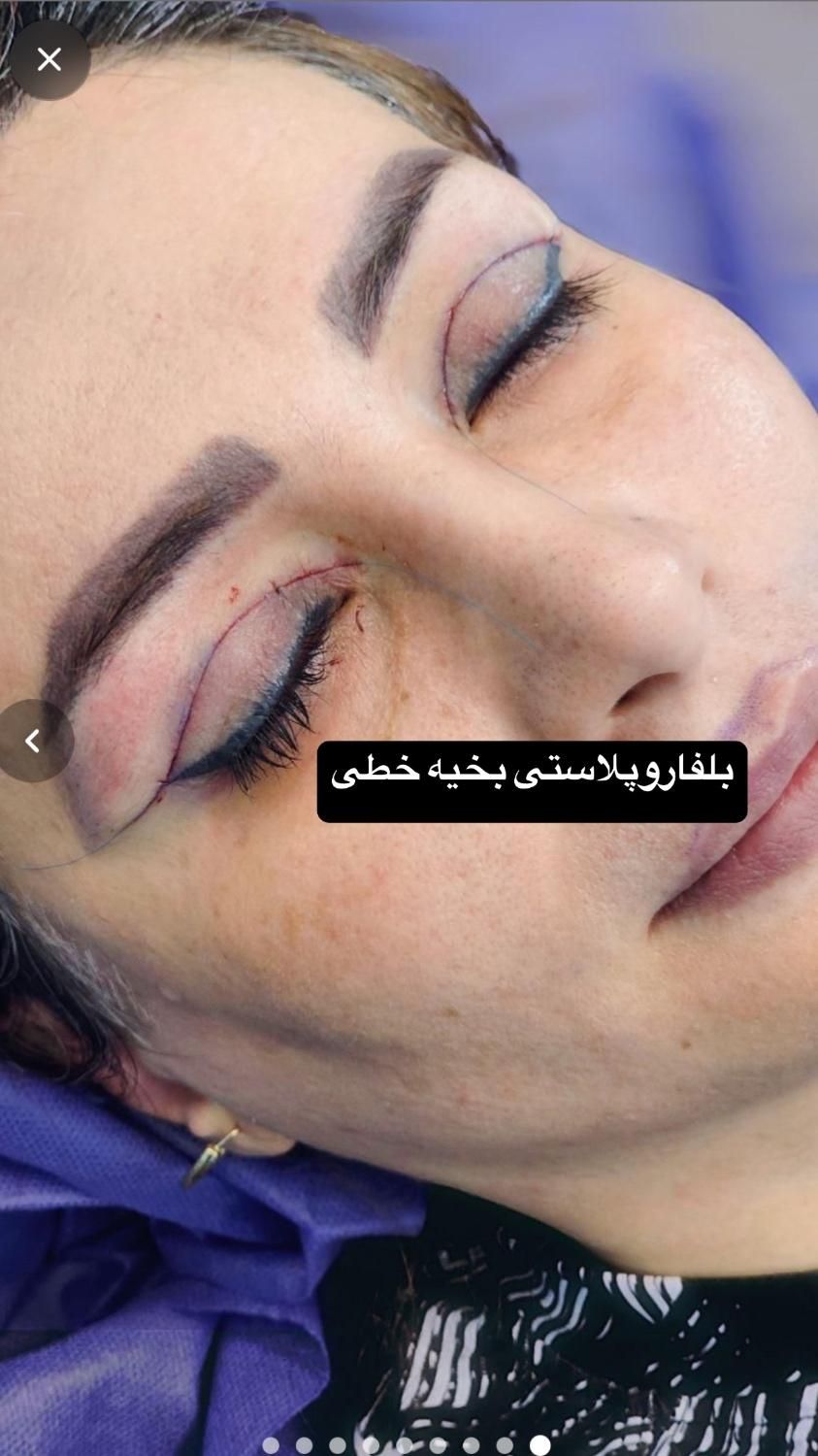 افتادگی پلک،بلفاروپلاستی،سانترال لب،بوکال فت،غبغب|خدمات آرایشگری و زیبایی|تهران, پاسداران|دیوار