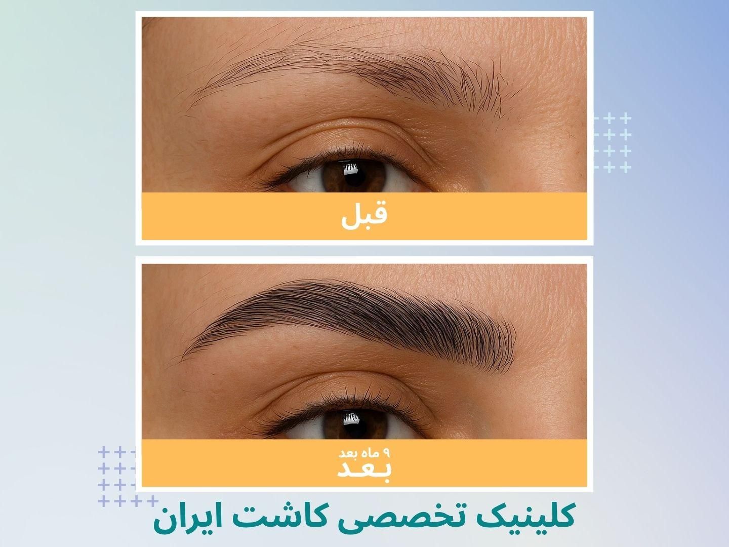 پیوند/ مو ابرو / روش DHI / با خط رویش پنهان|خدمات آرایشگری و زیبایی|تهران, دروس|دیوار