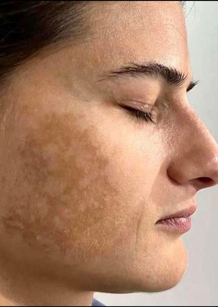 خدمات حرفه ای تخصصی،لک کک مک موی زائدسفیدالکترولیز|خدمات آرایشگری و زیبایی|قم, صفائیه|دیوار