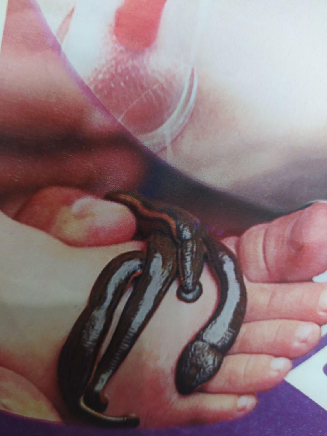 حجامت و زالوتراپی و طب سوزنی‌و پاکسازی بدن از سمو|خدمات آرایشگری و زیبایی|ارومیه, |دیوار