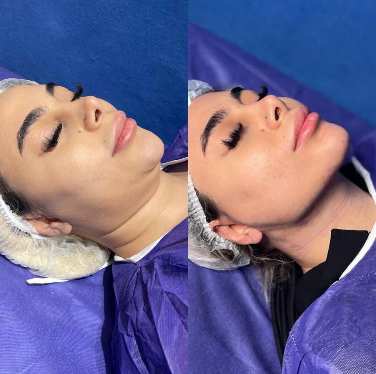سوپرساکشن غبغب همراه بازاویه سازی تخصصی گردنُ صورت|خدمات آرایشگری و زیبایی|تهران, پاسداران|دیوار