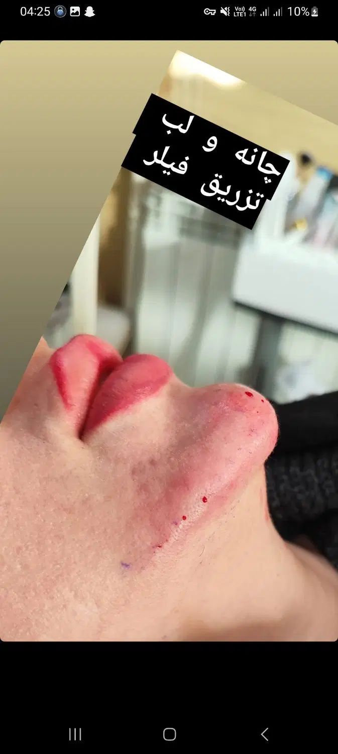 تزریق ژل وبوتاکس آموزش ژل وبوتاکس آنزیم فیلربادی|خدمات آرایشگری و زیبایی|کرمانشاه, |دیوار