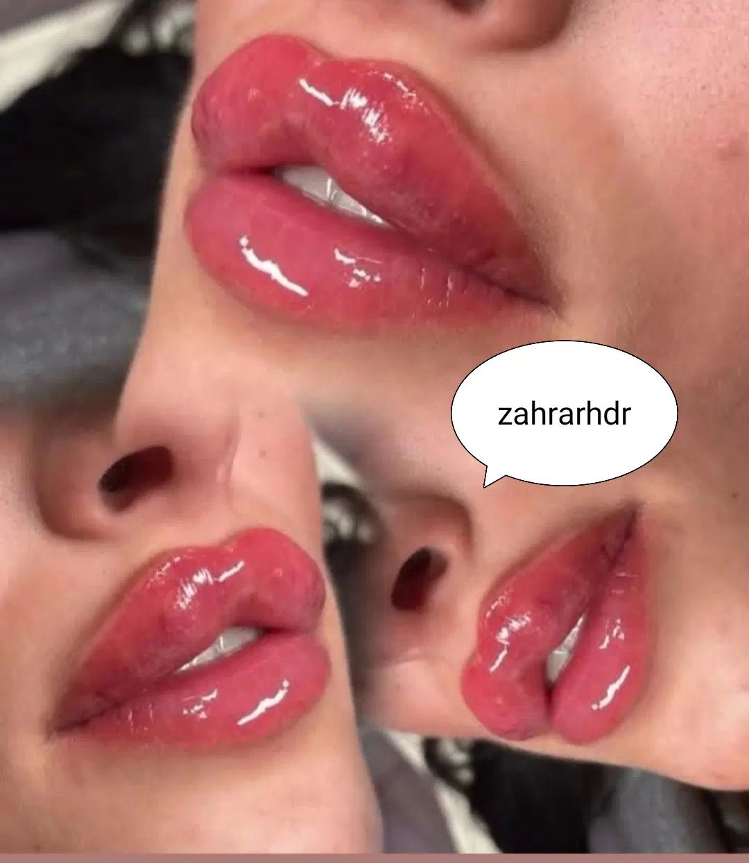 ژل فیلرلب چونه گونه اف ویژه نورامیس کاملا تخصصی|خدمات آرایشگری و زیبایی|زاهدان, |دیوار