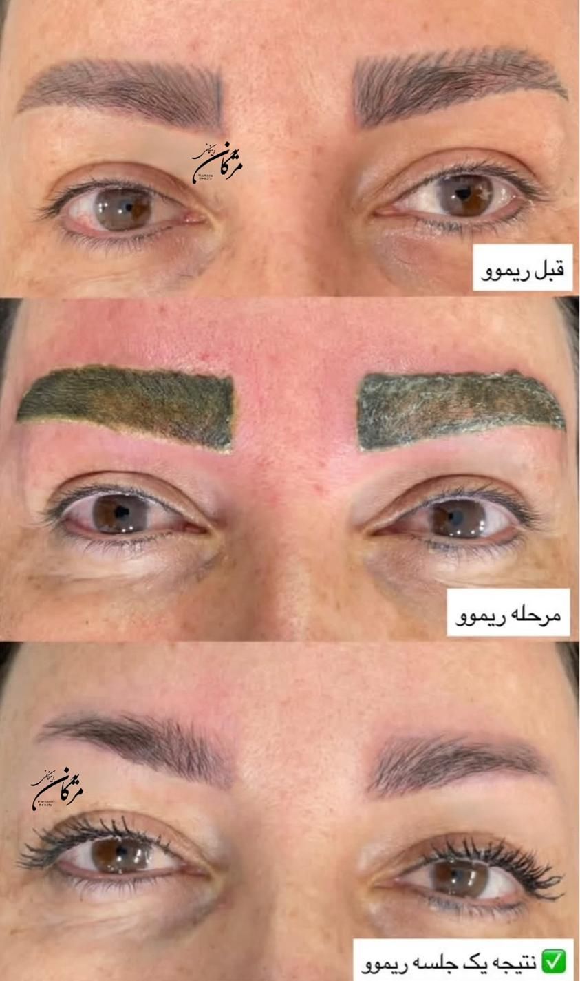 ریموو و پاک‌کردن تخصصی تاتو (تتو) ابرو بدون لیزر|خدمات آرایشگری و زیبایی|شیراز, معالی‌آباد|دیوار