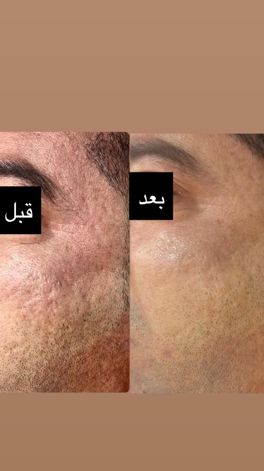 رفع گودی‌ صورت با تکنیک انحصاری و نتایج واقعی|خدمات آرایشگری و زیبایی|شیراز, ارم|دیوار