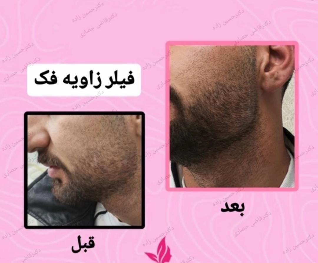 کلینیک لیزربوتاکس مزو دکترعلی حسین‌ زاده پرندبیمه|خدمات آرایشگری و زیبایی|پرند, |دیوار